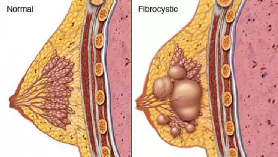 乳腺增生照片图片